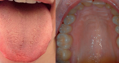 Burning Mouth Syndrome