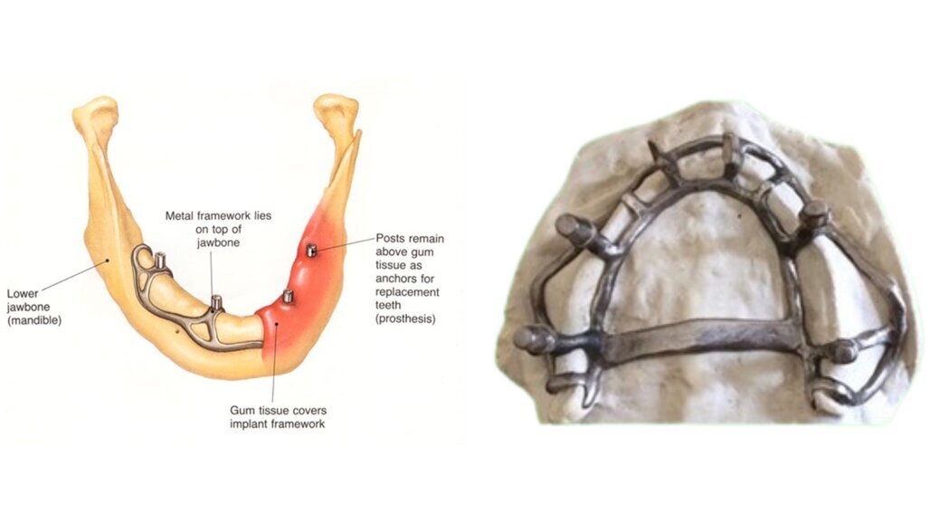 AMSJI bij de extreem geatrofieerde edentate maxilla