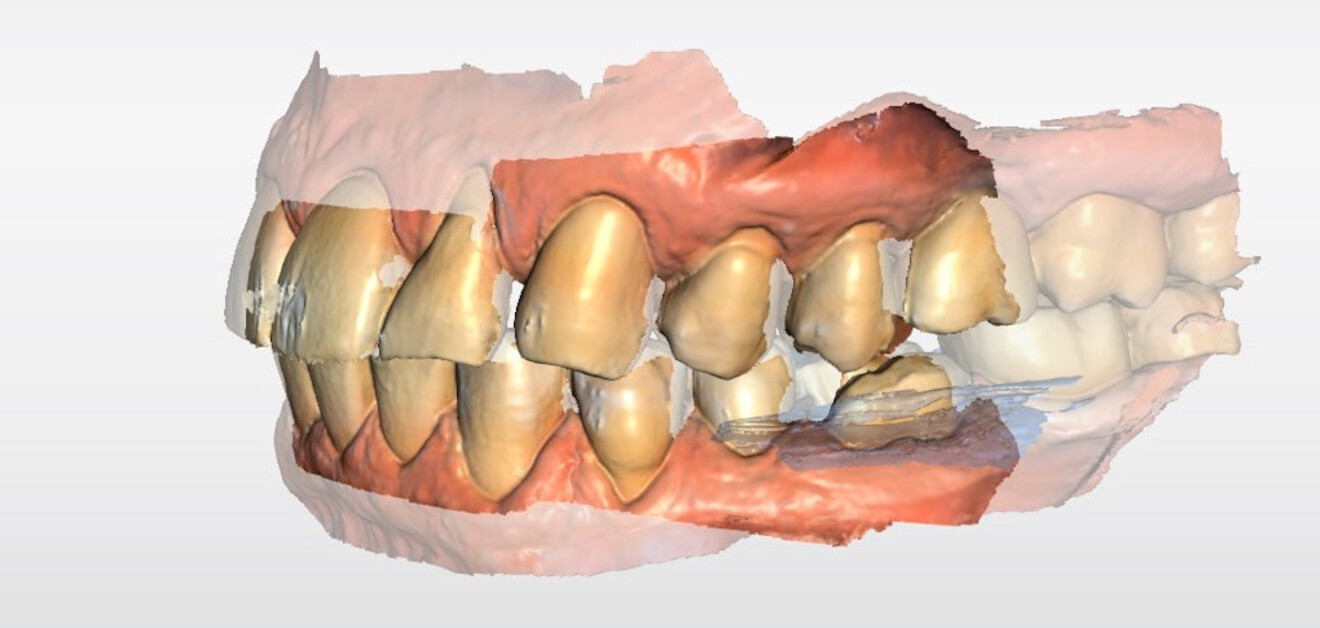 Fig. 15c: Initial intra-oral scans of the mandibular occlusal relationship.