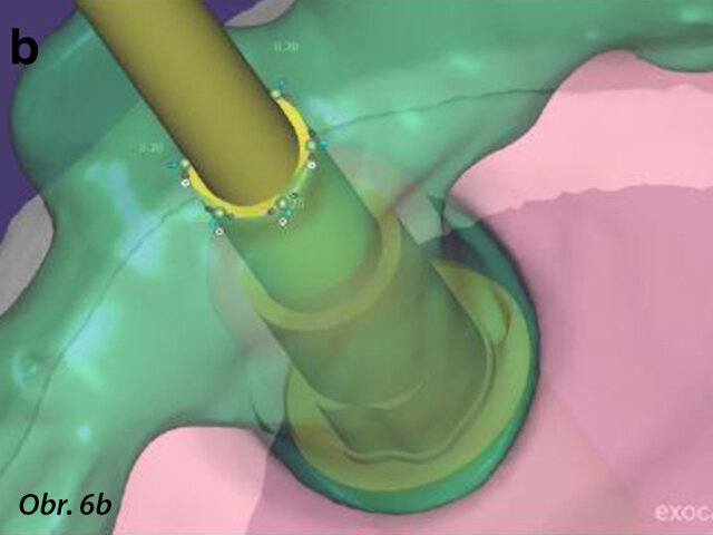 CAD návrh základní konstrukce provizorní fixní náhrady (a) a zvětšené snímky rozhraní mezi CAD základní konstrukcí a prefabrikovanými titanovými abutmenty (b, c).
