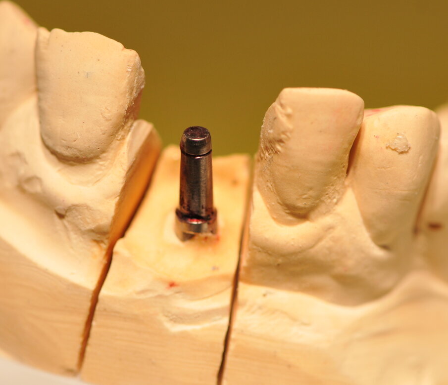 Fig. 7_Analogo del moncone sul modello in gesso.