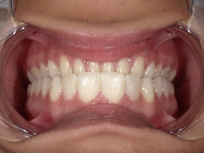 Fig 7 : Direct mock-up  to assess occlusion and obtain patient approval
