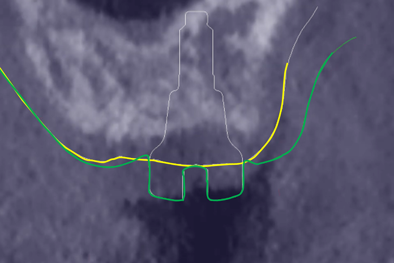 Fig. 4b: Merging of the STL file of the healing abutment (white line)