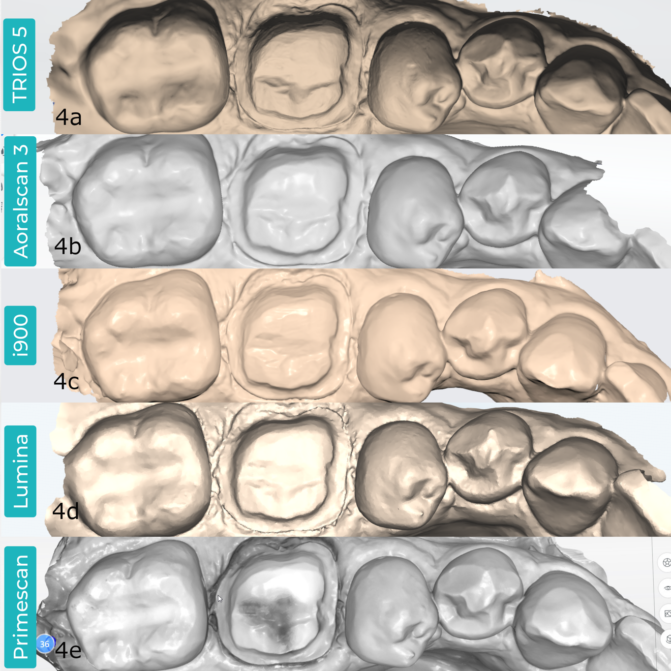 Figs. 4a–e: Processed monochromatic scans of the same tooth preparation, previewed in the scanners’ native software. TRIOS 5 (a). Aoralscan 3 (b). Medit i900 (c). ITero Lumina (d). CEREC Primescan (e).