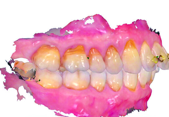 Slika 13.a i b: Usporedba profila mekog tkiva prije (gore) i poslije (ispod) implantacije s pomoću intraoralnog skena