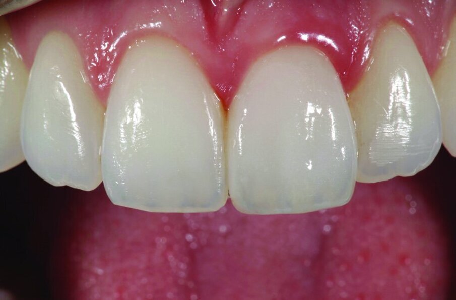 Figs 4, 5, 6 and 7: The versatile range of IPS e.max Ceram materials allows you to imitate bleached tooth shades showing lifelike light reflection.