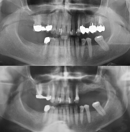 Fig. 1_La paziente presenta un’edentulia nel settore superiore posteriore sinistro (figura in basso) conseguente all’estrazione, avvenuta 2 anni prima, di alcuni elementi a supporto di un ponte da 2.4 a 2.7 (figura in alto, radiografia pregressa conferita dalla paziente).