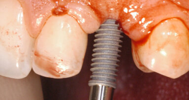 KAT Implants: Key Assisted Transfer system