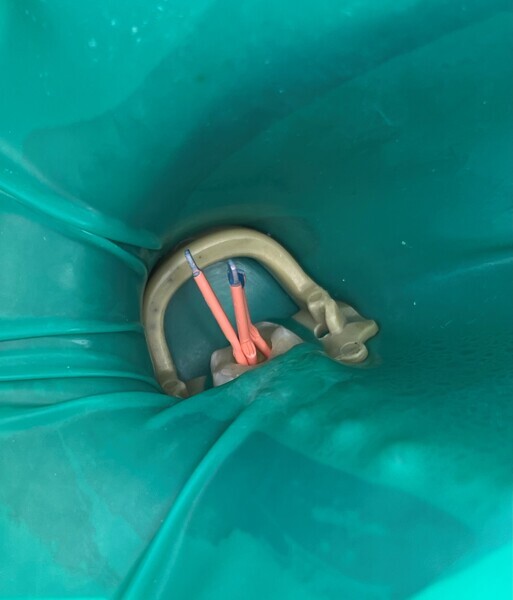 Fig. 6a: Master point fitting with 30/.04 HyFlex EDM gutta-percha points. Intra-oral view (a). Radiograph (b). Individual gutta-percha points (c).