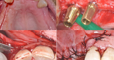 Tratamiento de defectos óseos con biomateriales y técnicas de barrera