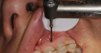 Ostéo-activation : dix-neuf ans de recul