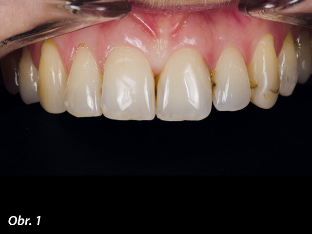 Obr. 1, 2: Původní situace: zuby 22 a 23 vyžadují ošetření.