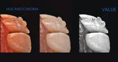 Smile rejuvenation with  Biosmart restoratives
