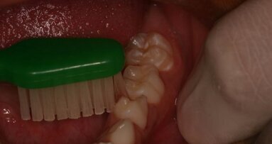 Ultra-conservative treatment (UCT)