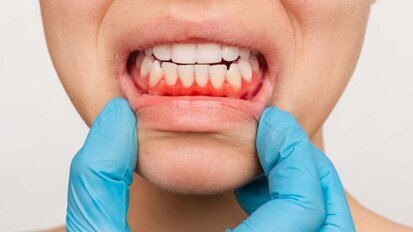 Früherkennung von Gingivitis durch neuen Test Früherkennung von Gingivitis durch neuen Test