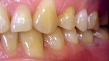 Interdyscyplinarne podejście do leczenia implantoprotetycznego