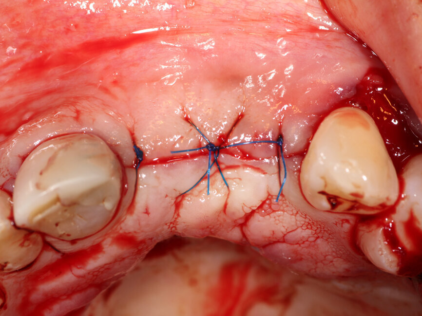 Fig. 14: Flap is closed without tension using 5-0 Polypropylene suture (Riverpro, Osteolife Biomedical, Jupiter, Fla.) in a simple interrupted pattern. 
