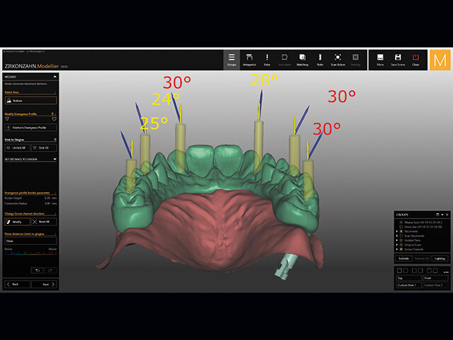 Software umožňuje ručně změnit sklon kanálů pro šroubky, nicméně pro přesné výsledky se v případě disparalelně zavedených implantátů důrazně doporučuje použití titanových základen K80 a MUA 17 °.