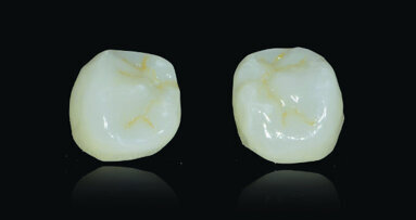 Restoring implants using lithium-disilicate,CAD/CAM fabricated restorations