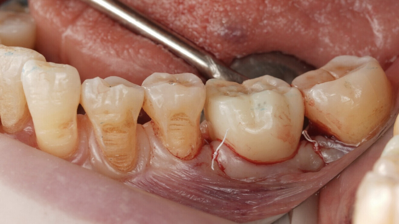 Fig. 13: Crown permanently screwed in place using a calibrated torque wrench.