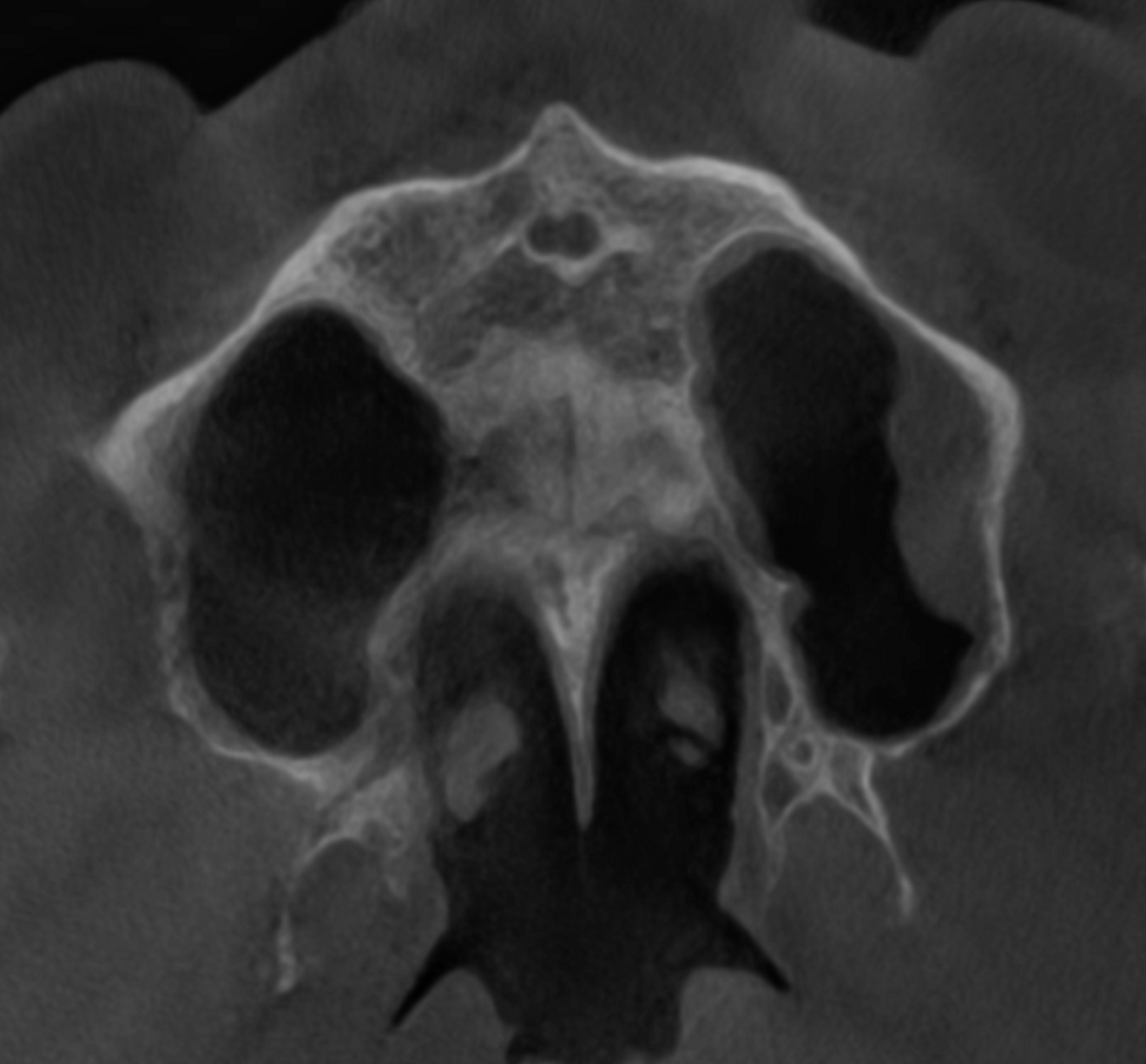Fig. 9c: Mid-level transversal cross-section of the maxilla showing the completely healed maxillary sinus