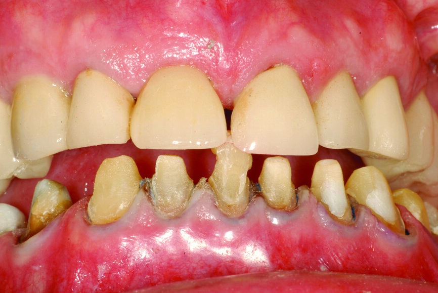 Fig. 21: Composite resin device at the desired vertical dimension of occlusion stabilises the mandible in centric relation.