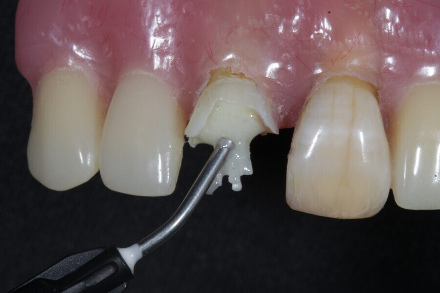 Fig. 11: The coronal portions of the fibre-reinforced flexible micro-posts are covered with a fibre-reinforced flowable composite (Fibrafill FLOW, ADM).