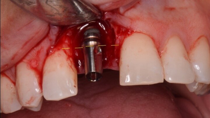 Figura 8. Esperamos a que la superficie del implante esté siempre cubierta por un coágulo de sangre antes de adaptar el material encima de éste.