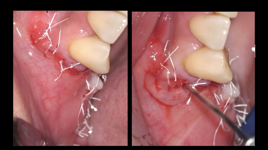Fig. 6 - Chiusura del lembo ed applicazione finale di Regenfast sulla linea di sutura.