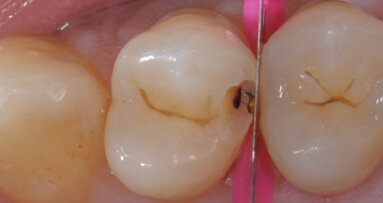 Restauri diretti in composito con le nuove matrici V4-Ring Micerium