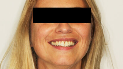 Matching of CBCT and virtual wax-up for single-tooth replacement of a central incisor