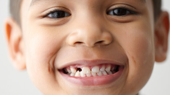 Elk kwartier wordt er in het VK een kindertand geëxtraheerd