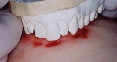 “Bijtafdruk niet meer gebruiken als forensische methode”