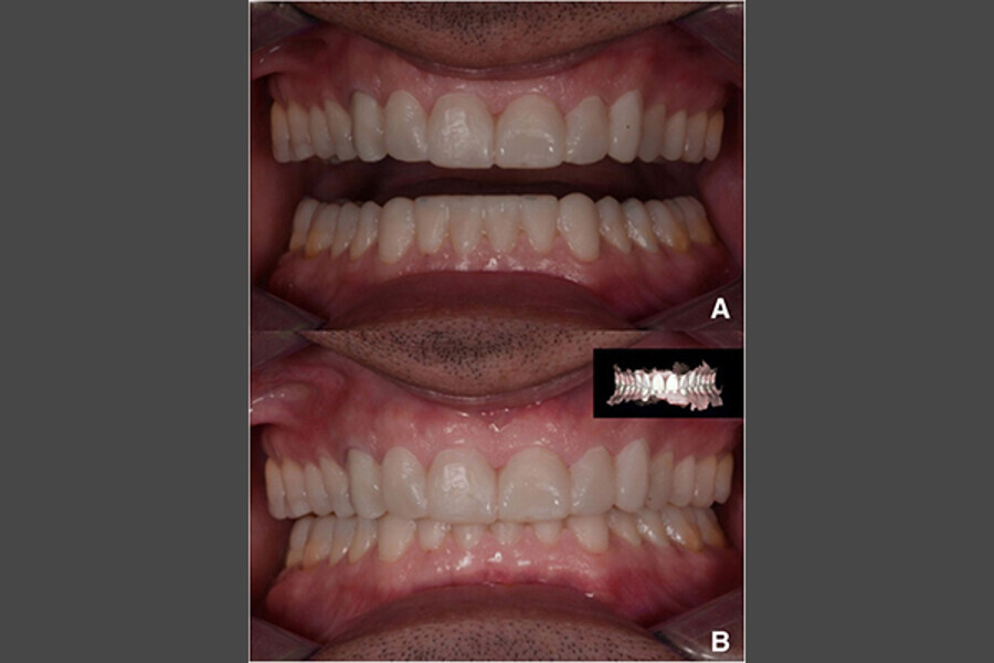 Fig. 6. a Mock-up motivacional. b Mock-up motivacional y escaneo intraoral.