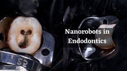 Nanorobots will prevent root canal treatment failures