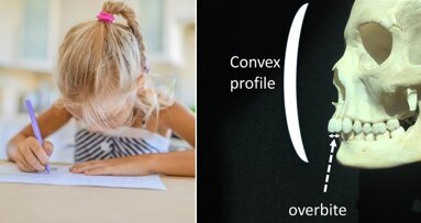 Study confirms link between slender jaws and left-handedness