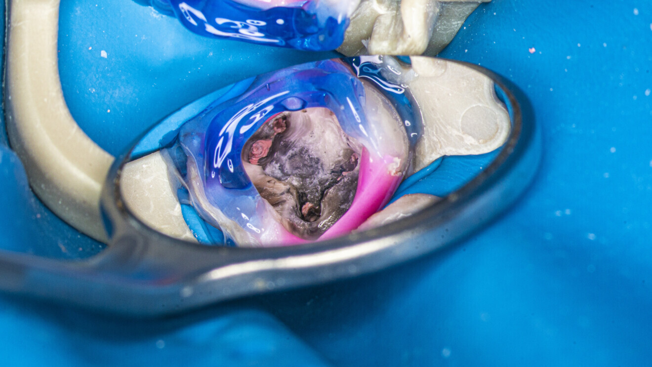 Fig. 29: Tooth after removal of the caries and sealing of the chamber with flowable composite and dental dam.