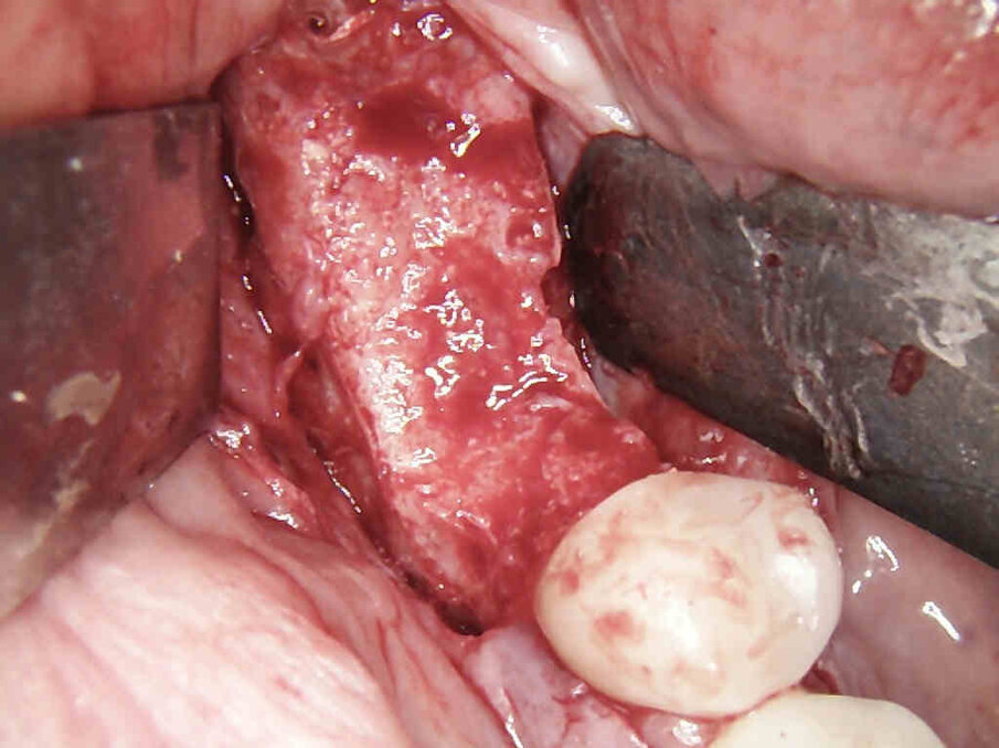 Figg. 11, 12_Si evidenzia formazione di osso al di sopra della membrana e si procede alla rimozione della stessa.