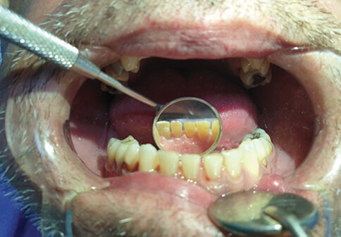 Sl. 1.4: Pacijent A, kontrola nakon 4 meseca od prelaska na bezdimni duvanski proizvod