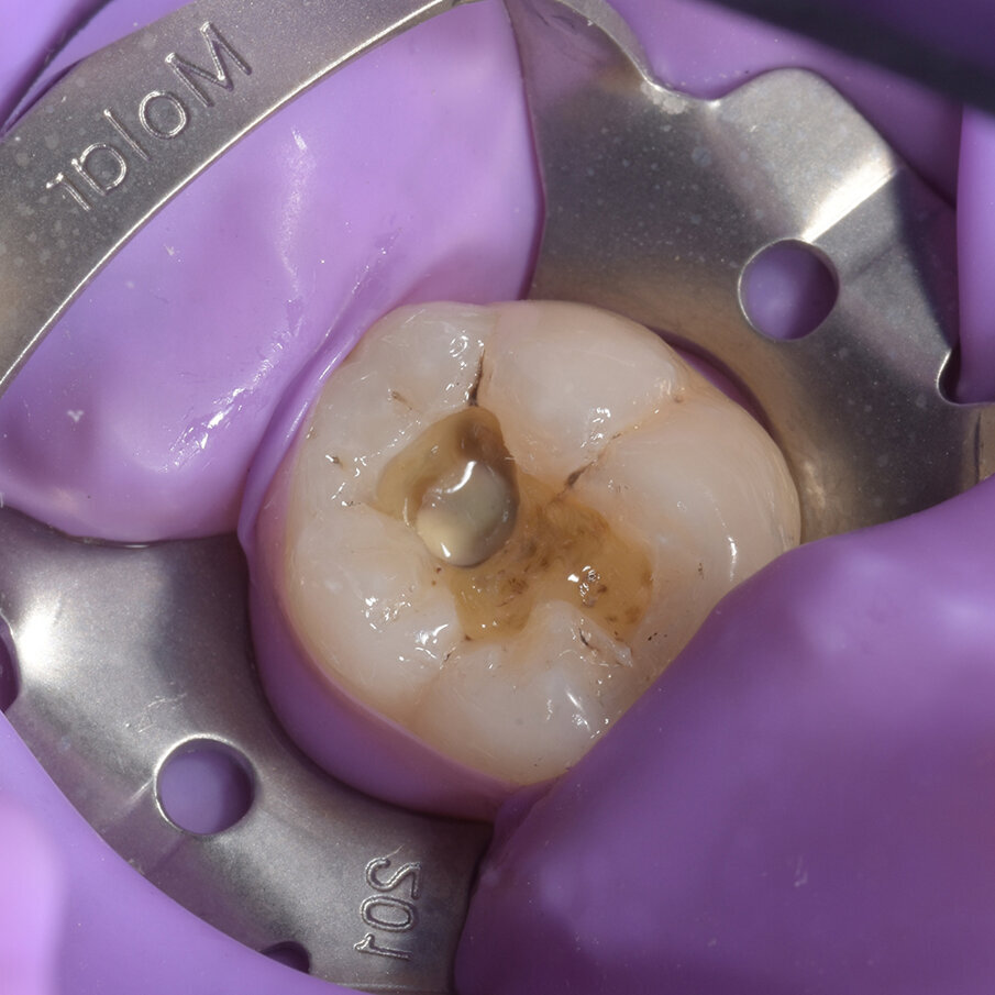 Fig 6: After placement of Beautifil Opaquer UO 