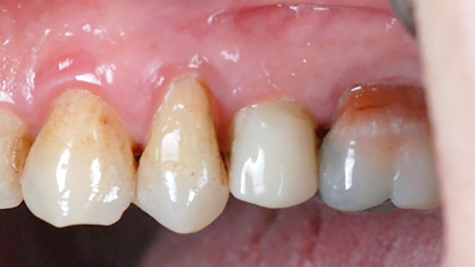 âThe Patent Dental Implant System is the best choice for every patient and dentistâ