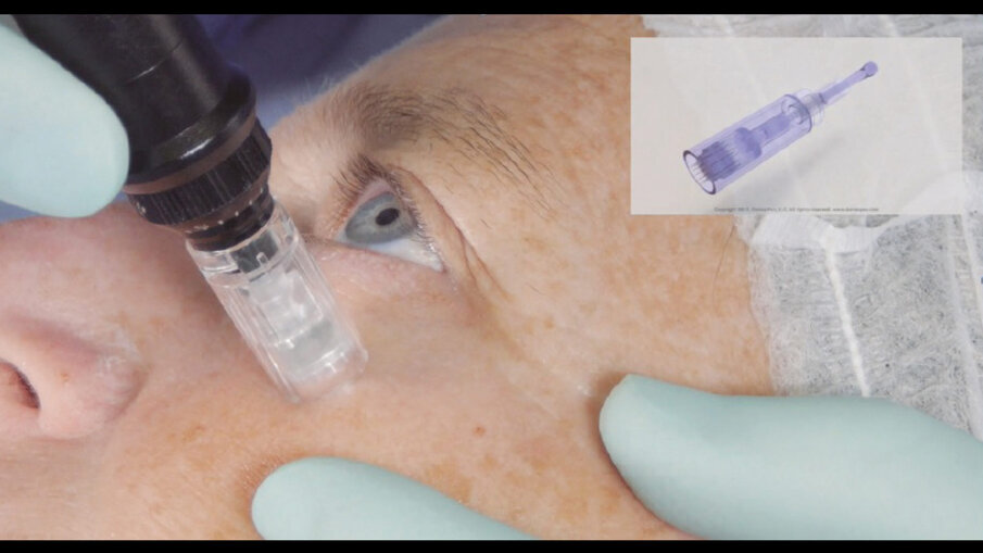 Fig. 1 - Tecnica transdermica.