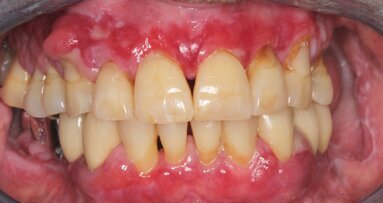 Tratamiento de paciente con trasplante e hiperplasia gingival