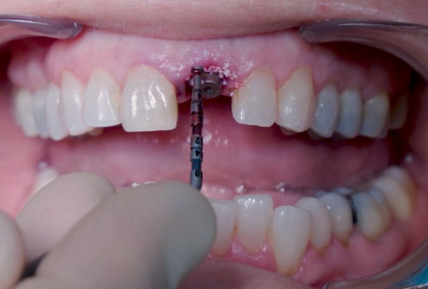 Fig. 16: Granule condensation with surgical probe.
