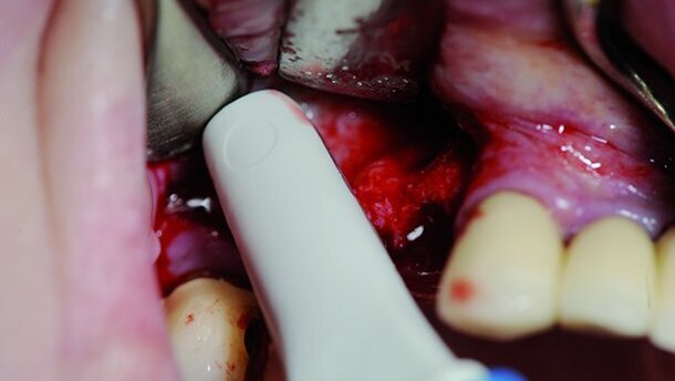 Augmentation osseuse – une base importante pour le concept du traitement implantaire