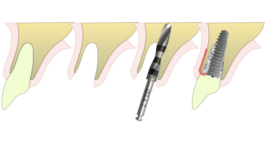 Fig. 9_Posizionamento ideale di un impianto in area estetica.