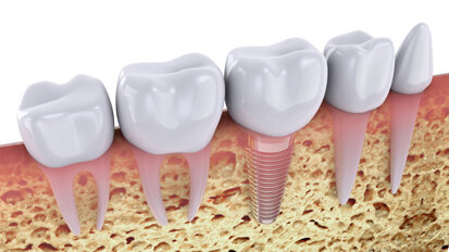 Zóny na CBCT čelisti