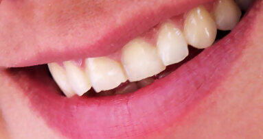 Aantal vrouwen met mondkanker toegenomen