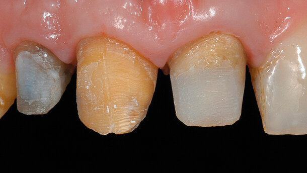 Riabilitazione protesica in area ad alta valenza estetica tra tecniche tradizionali e digitali