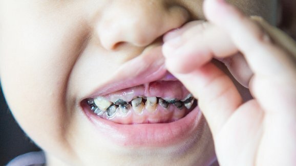 Produženo dojenje povećava rizik za razvoj karijesa